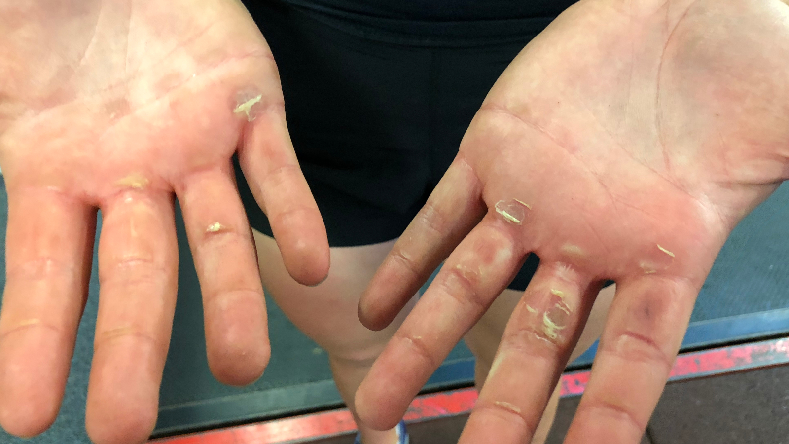 Rowing hand care: blister tips - British Rowing